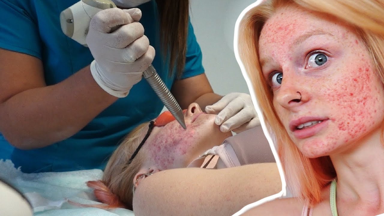 Getting Acne + Scarring LASER Treatment