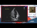 Echocardiography for PFO closure