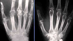 See Arthritis Joint Degeneration X rays & Healthy Joints