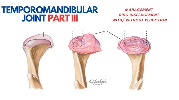 Management of Disc Displacement with/without Reduction (TMJ) : Part III