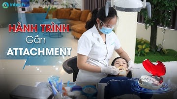 GẮN ATTACHMENT TRONG NIỀNG RĂNG INVISALIGN- HÀNH TRÌNH THEO CHÂN KHÁCH HÀNG