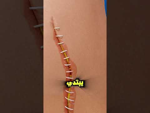 ازاي الدكتور بيعالج الجرح بالغرز 