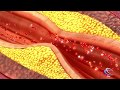 Carotid Endarterectomy Neurosurgery at Carilion Clinic