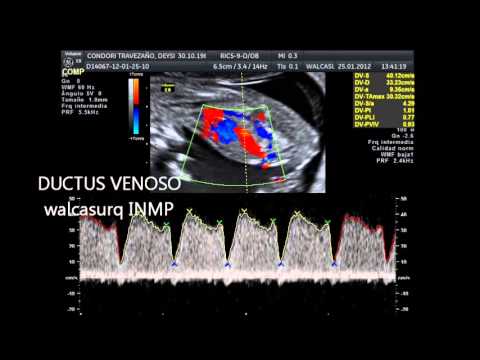 DUCTUS VENOSO - YouTube