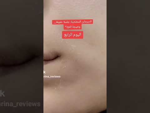 الديرمابن السطحية جلسة خفيفة ونتيجة تلمع