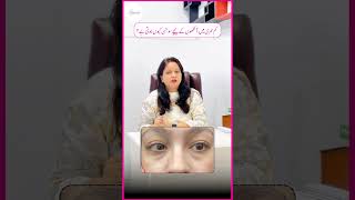 Kam Umri Mein Aankhon Ke Neechay Eye Bags Kyun Hotay Hain? - Eye Bags at a Young Age?