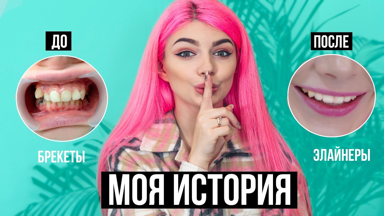 Моя История Выпрямления Зубов 😬  Удаление, Брекеты, Элайнеры, Импланты | До и После + Ответы