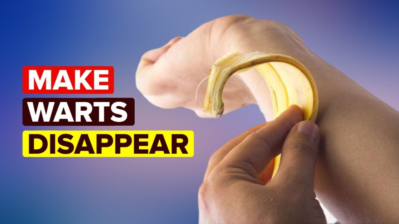 Wart treatment banana peel - Oxiuros como eliminarlos