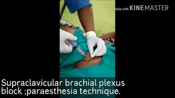Supraclavicular plexus block-paraesthesia technique.