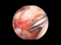 Repair of Massive Acute Rotator cuff tear &amp; Subscapularis tear