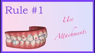 Attachments Fundamentals - Invisalign Mini Course 2 of 8