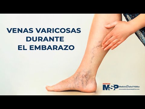 Video: Venas varicosas en el embarazo