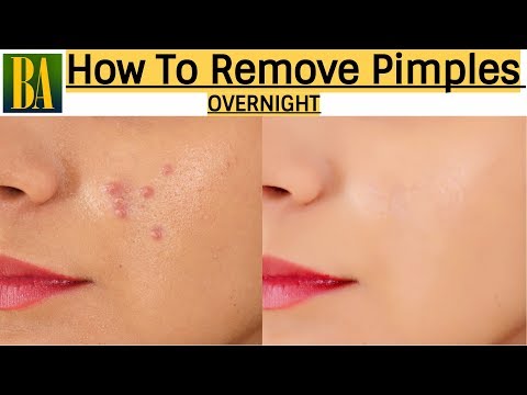 How To Remove Pimples Overnight - एक रात में Acne और पिम्पल्स का सफाया कैसे करे - Best Home Remedy - 동영상
