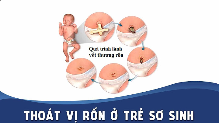 Polyp rốn ở trẻ sơ sinh là gì năm 2024