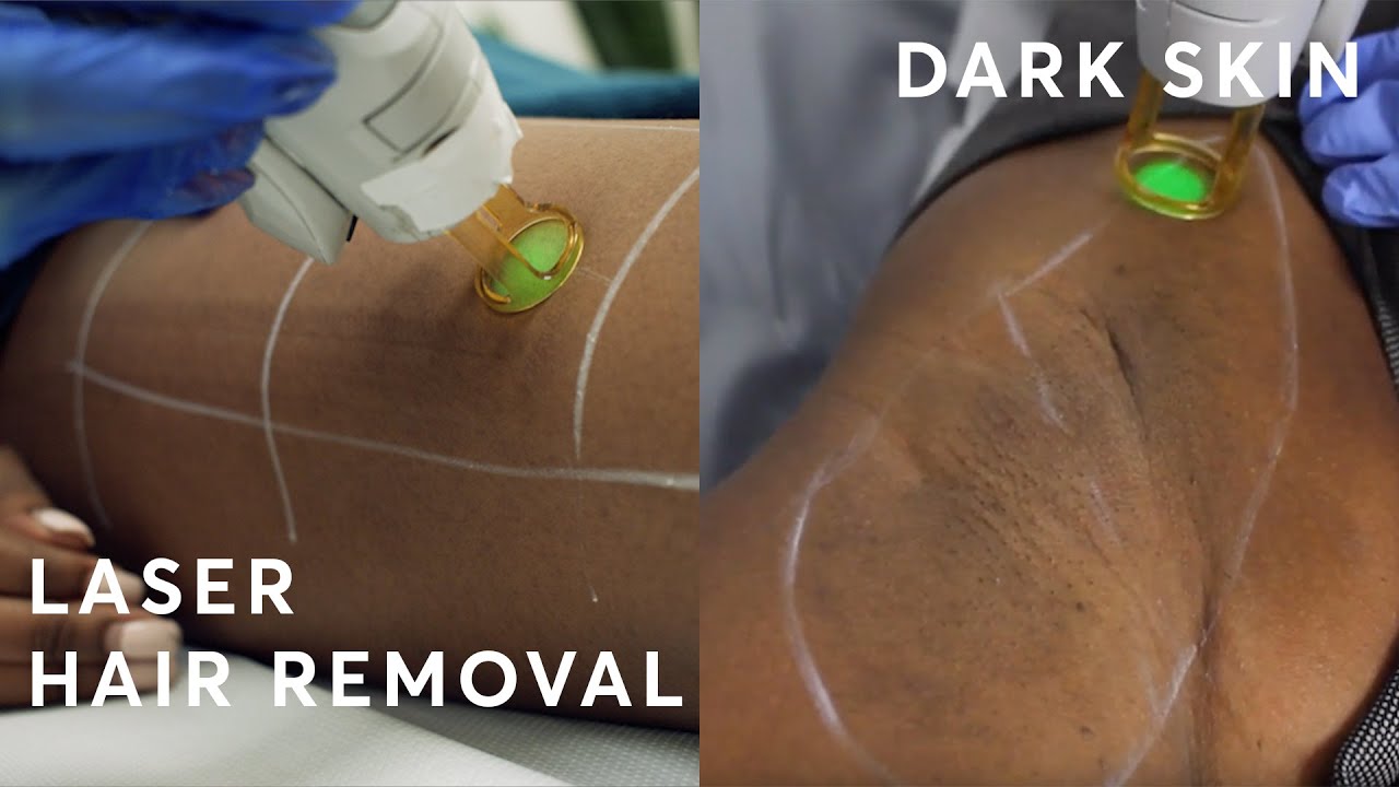 Laser Hair Removal on DARK SKIN! Is it suitable? - thptnganamst.edu.vn