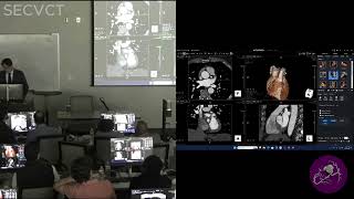 Case Analysis with Dr. Bruno Lima (Part 1 of 8) | SECVCT