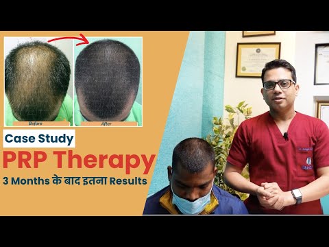 PRP Does The Cure For Hair Loss Lie Within Our Blood? - video
