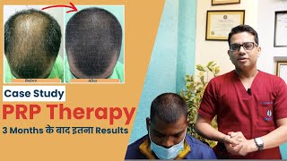 Case Study - PRP Treatment Results after 3 Months | PRP for Hair | Hair Transplant in Delhi