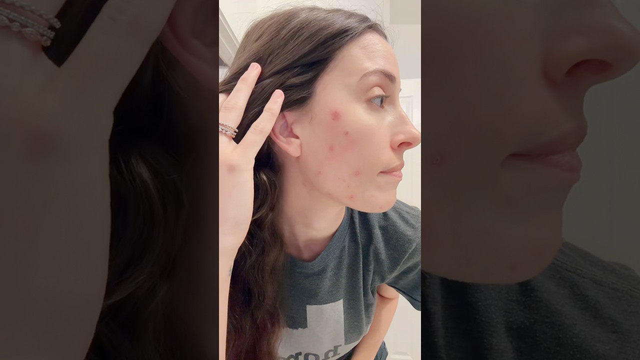 Skin issues after getting glutened 