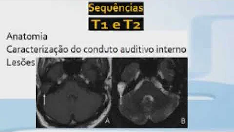 Como é feito o exame de ressonância magnética do ouvido?