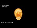 Postoperative evaluation of orthognathic patients with Amira Software