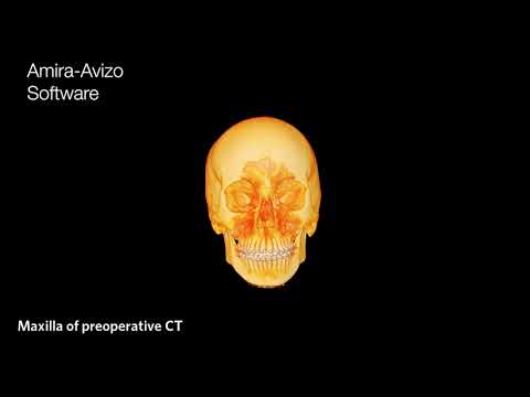 Postoperative evaluation of orthognathic patients with Amira Software