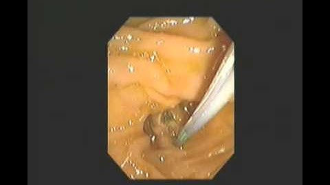 ERCP - Recut Sphincterotomy & Stone Extraction - STEFANOS DOKAS The ERCP Channel