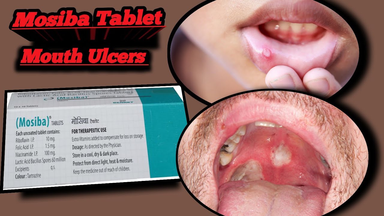 Mosiba Mosiba Tablet | Mouth Ulcer | Uses | Side Effects | Dose all ...