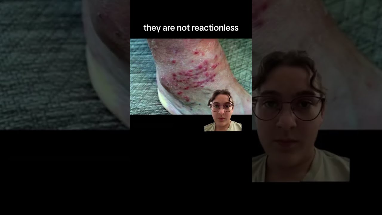 Did You Know Chiggers Can Really Pack A Bite 