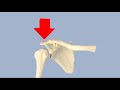 Acromioclavicular Separation