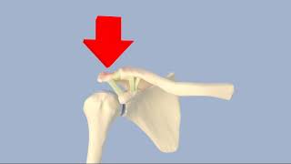 Acromioclavicular Separation