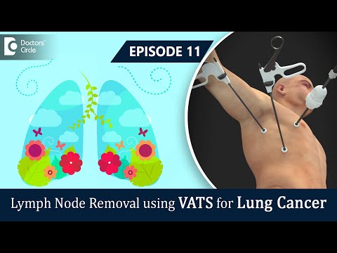 Lymph Node Dissection Under VATS For Lung Cancer Treatment - Dr. Sandeep Nayak & Dr. Bharath G