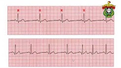 latihan interpretasi EKG Dasar Syahrul Ningrat - Durasi: 53.20. 