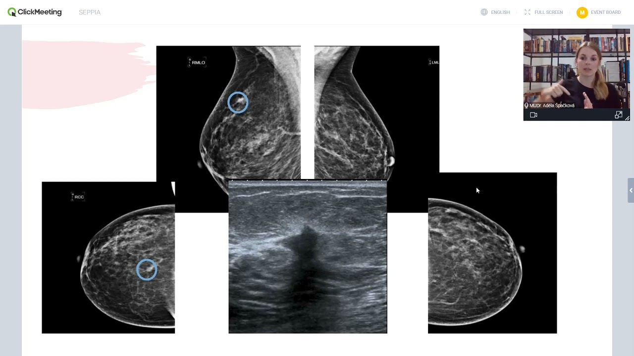 MUDr. Adéla Špačková - Rakovina prsu a její prevence