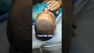 For appointment: 03321925466 #hairlinerestoration #viral #hair #foryou #hairstyle