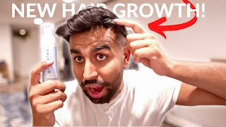 How To Use a Derma Roller and Minoxidil For Hair Growth