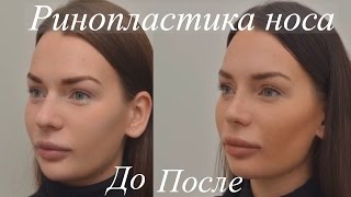 Ринопластика До и После - Пластика Носа(, 2016-12-16T13:02:44.000Z)