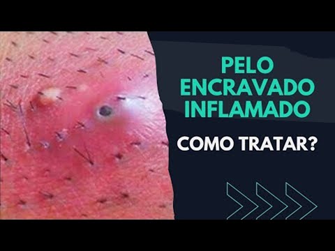 Vídeo: Como tratar os pêlos do nariz encravados: 11 etapas (com fotos)