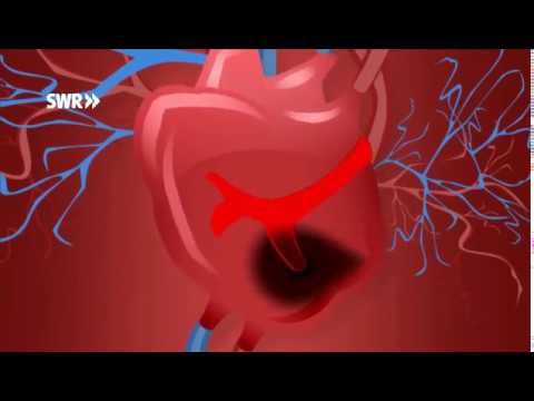Video: Wie Hoher Blutdruck Schlaganfälle Verursacht