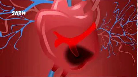 Was macht der Kardiologe bei Bluthochdruck?