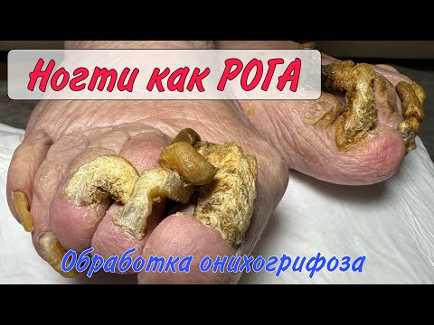 Толстые ногти / как срезать толстые ногти / онихогрифоз / грибок ногтей