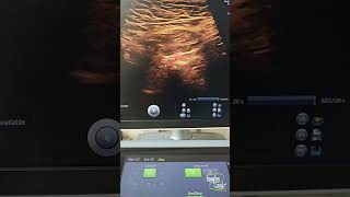 Direct Inguinal Hernia || Ultrasound