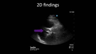 Point-of-Care Echo: Aortic Stenosis vs. Sclerosis