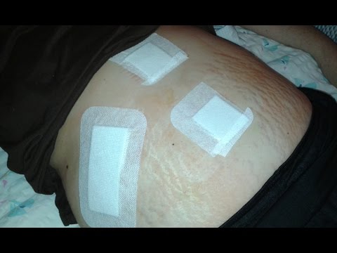 Videó: Cardiff Ráktörténete, 2. Rész - Bélmassza Műtéti Eltávolítása