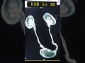kub in 3D CT IMAGE