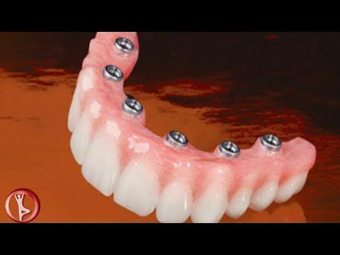 all on 6 dental implants treatment options in tijuana mexico youtube dental implants in mexico