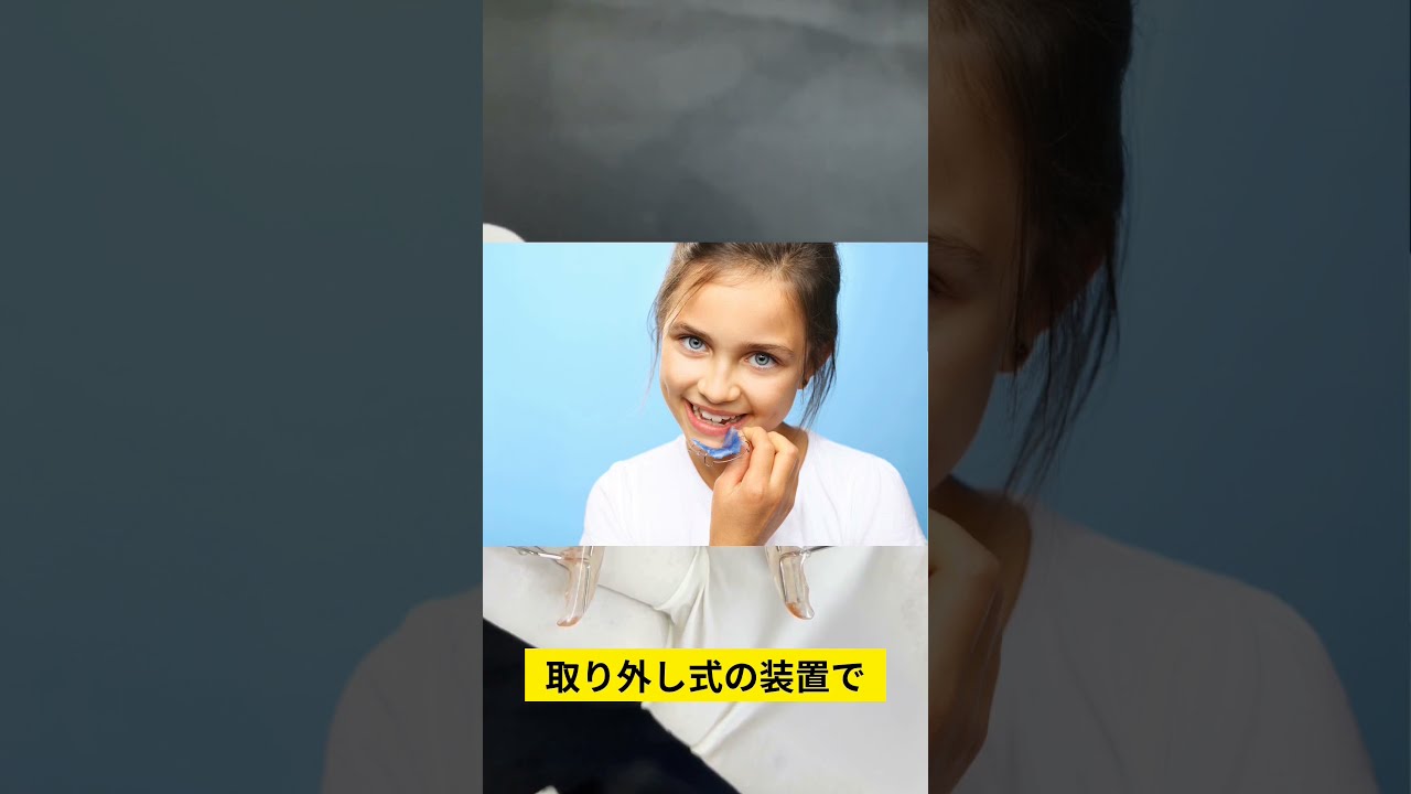 可撤式矯正装置入門 可撤式装置｜スマイルガイド 矯正歯科の正しい選択を応援するサイト