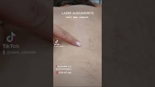 Daphne Valavani Aesthetics Laser Alexandrite