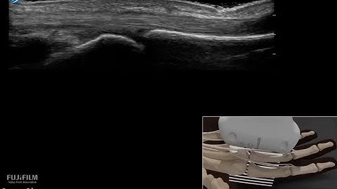 How To: Pathology Hand A1 Pulley Trigger Finger 3D Video