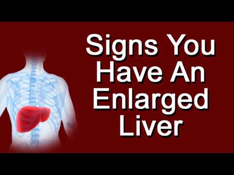 Signs You Have An Enlarged Liver